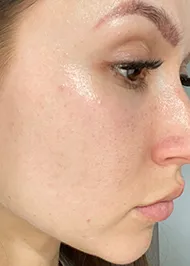 woman without acne after